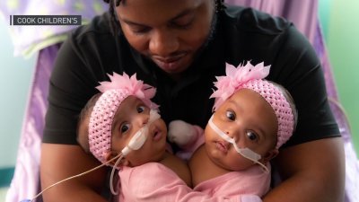 Cook Children's Performs Its First-Ever Separation of Conjoined Twins
