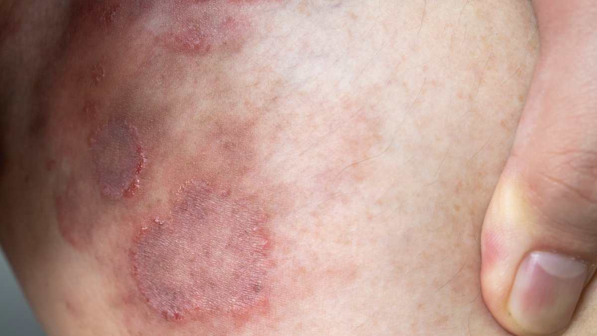 First Resistant Ringworm Infections Detected in United States – NBC 5 Dallas-Fort Worth - Vimarsana News