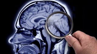 FILE - An MRI scan of an Alzheimer's patient's brain.