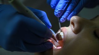 File. This photograph taken shows a close-up view of a dentist working on a patient at a dental clinic in Istanbul. – Attracted by unbeatable prices, fast turnaround times and the promise of a bright smile, 150,000 to 250,000 foreign patients will travel to Turkey for treatment this year, according to the Turkish Dental Association (TDB), making the country one of the main destinations of world dental tourism. (Photo by Ozan KOSE / AFP) (Photo by OZAN KOSE/AFP via Getty Images)