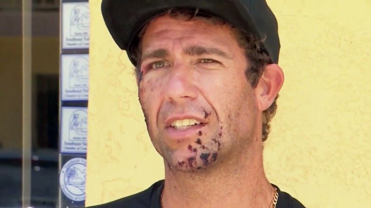 Surfer details getting bit in the face by shark: ‘Felt like a bear trap’