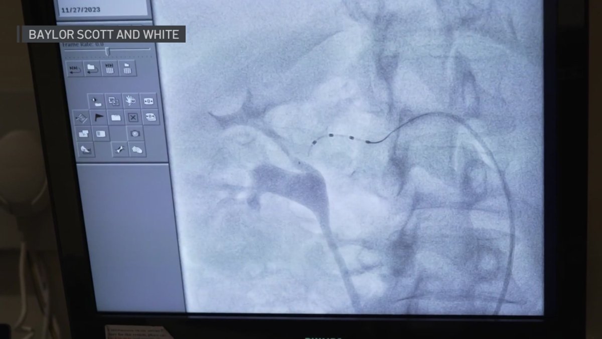‘Game changer' hypertension procedure could help people with resistant high blood pressure