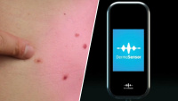How an AI device the size of a phone detects skin cancer