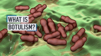 What is botulism?