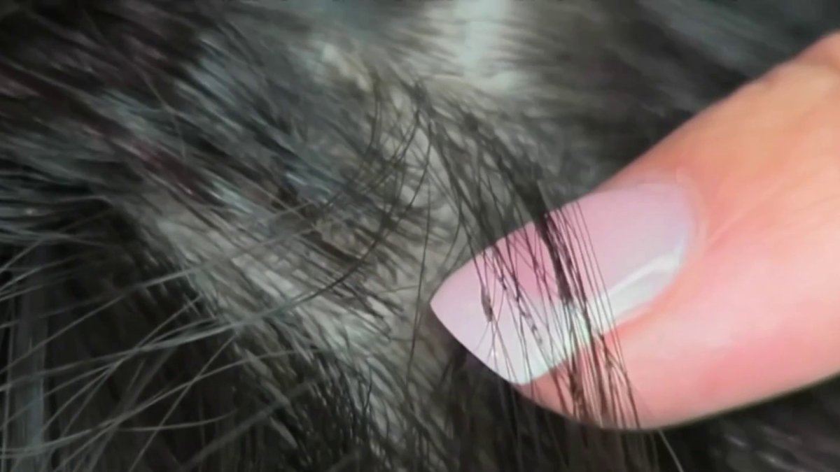 Tips for preventing and treating lice NBC 5 DallasFort Worth