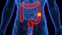 Colon cancer, illustration