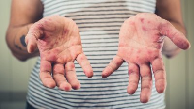 Health officials warn against misleading measles information
