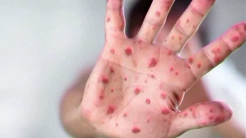 Texas measles outbreak reaches DFW, linked cases in Collin and Rockwall counties