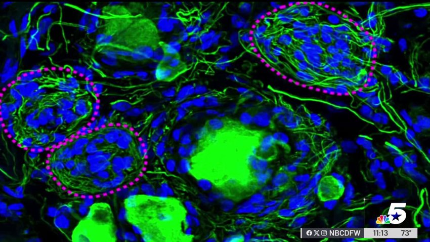 UTD scientists solve mystery behind diabetic nerve damage
