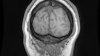 Texas woman's death shines light on dangers of brain-eating amoebas