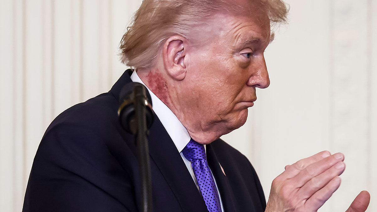 White House addresses ‘redness' on the side of Trump's neck