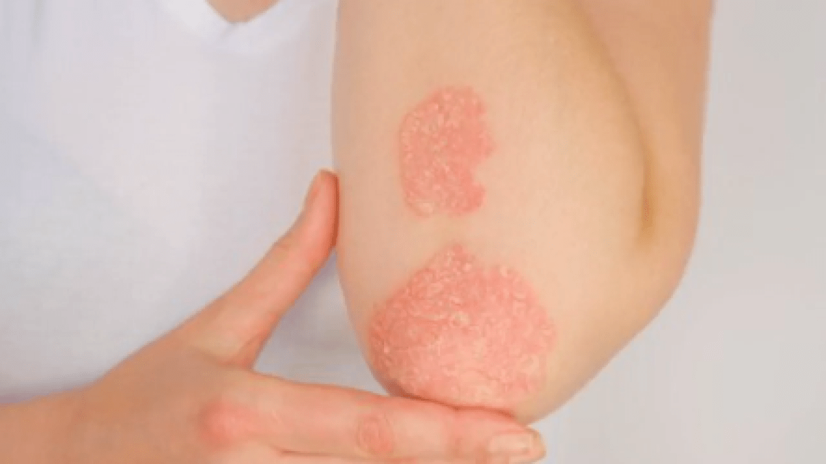 GLP-1 drugs may have an unexpected benefit for some skin conditions