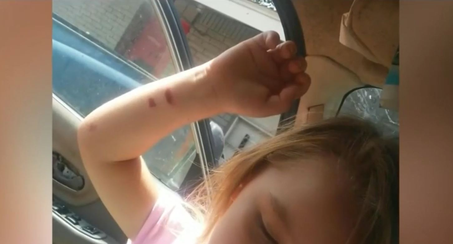 Mom Wants Answers After 3-Year-Old Burned By Cell Phone