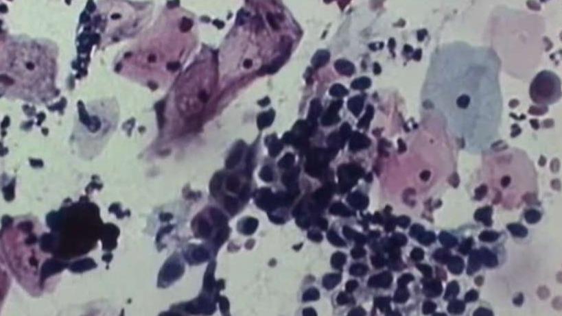 New Cervical Cancer Guidelines Could Make Pap Smears Sparse