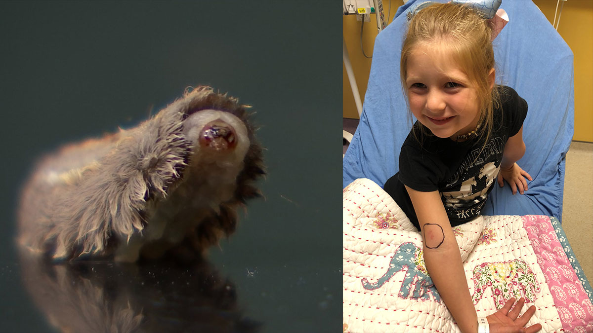 Rockwall Child Hospitalized After Venomous Caterpillar Sting